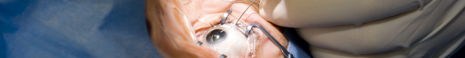 Bientôt, plus besoin de chirurgie pour soigner la cataracte ? 