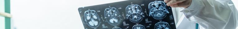 Maladie d’Alzheimer : augmenter les apports en oméga-3 pour réduire le risque de moitié 