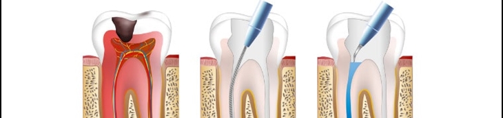 désobturation endodontique remboursement mutuelle