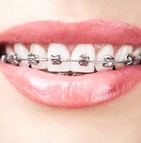 Mutuelle prothèse dentaire bridge couronne implant dentaire
