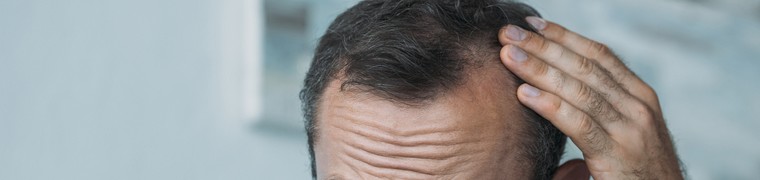 Calvitie : quelles précautions prendre pour limiter les dégâts ?