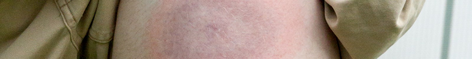 La prise en charge de la maladie de Lyme présente quelques avancées