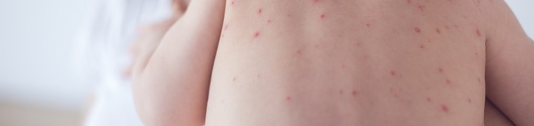 La progression de l’épidémie de rougeole en France est en partie due à un faible taux de vaccination