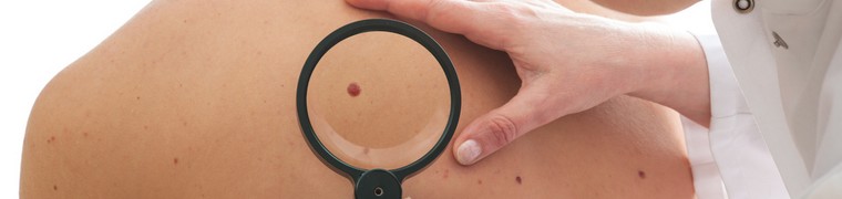 Les symptômes cancérigènes de la peau frappe une grande majorité des Britanniques
